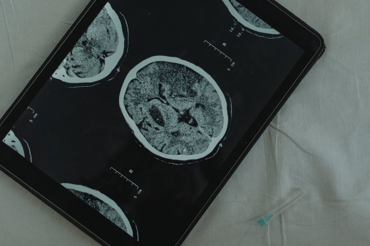 gallery-1 Close-up view of a brain CT scan displayed on a digital tablet with a medical needle beside it.